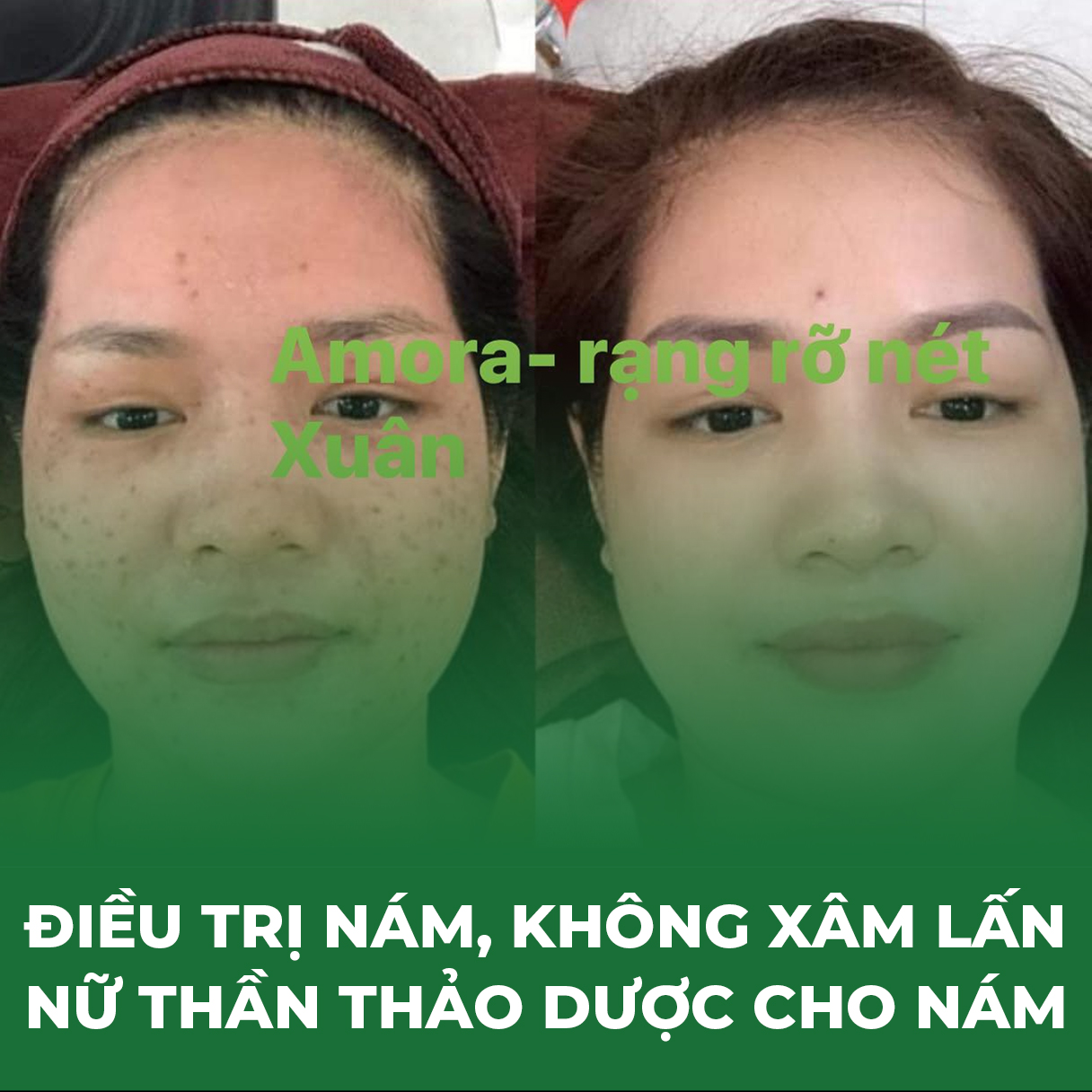 https://thammyamora.com/Dịch vụ điều trị Nám, không xâm lấn, nữ thần thảo dược cho Nám. Bảo hành trọn đời.