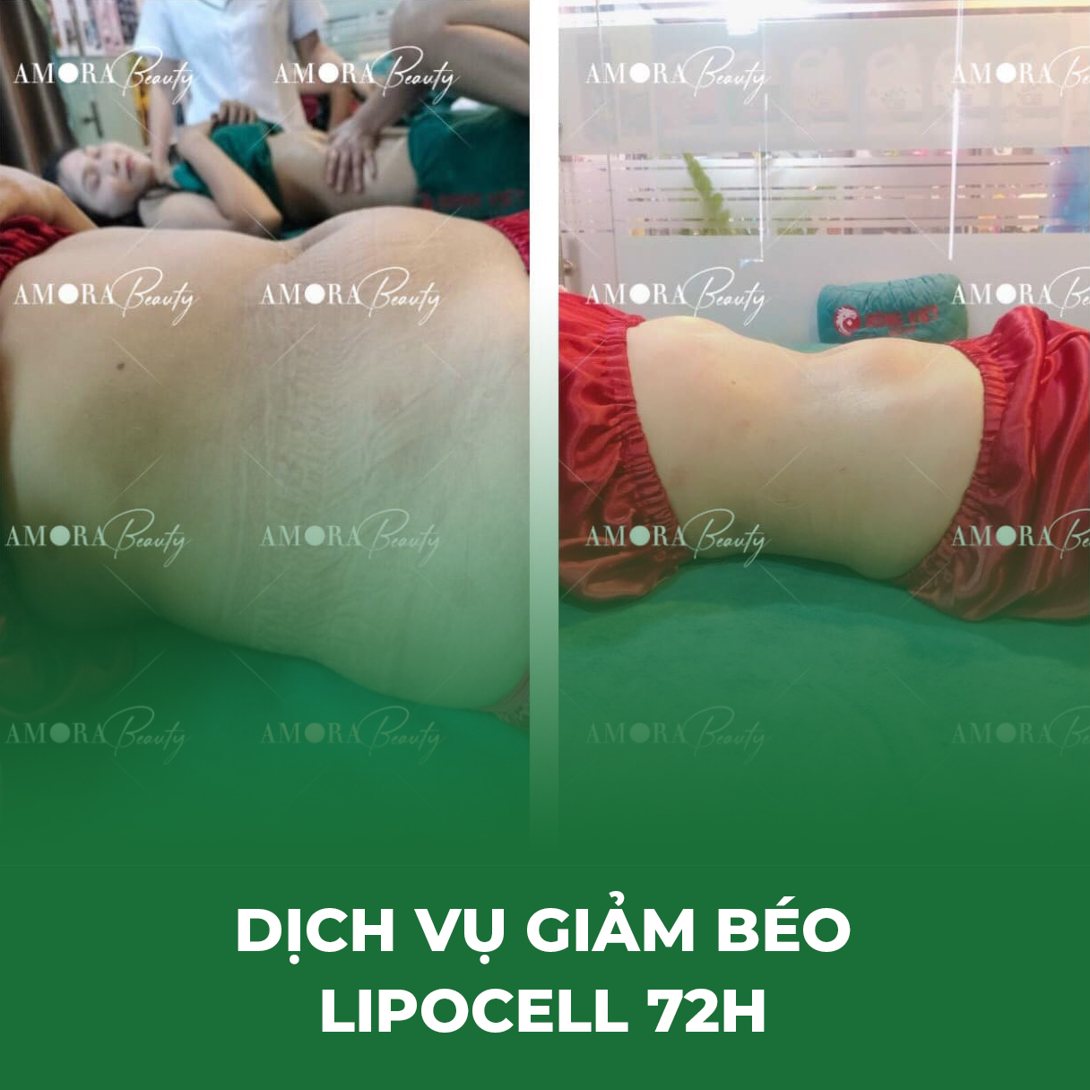 https://thammyamora.com/Dịch vụ giảm béo Lipocell 72h. Hiệu quả tức thì, duy trì dáng đẹp.